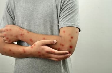 Pennsylvania Reports 2 Measles Deaths, First In 35 Years - Merck & Co (NYSE:MRK)